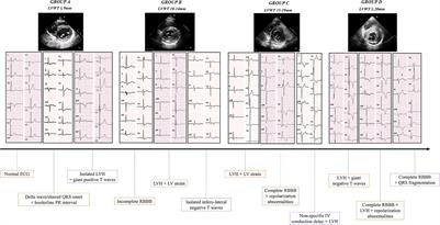 Electrocardiogram analysis in Anderson-Fabry disease: a valuable tool for progressive phenotypic expression tracking